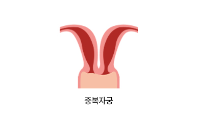 중복자궁