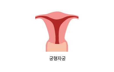 궁형자궁